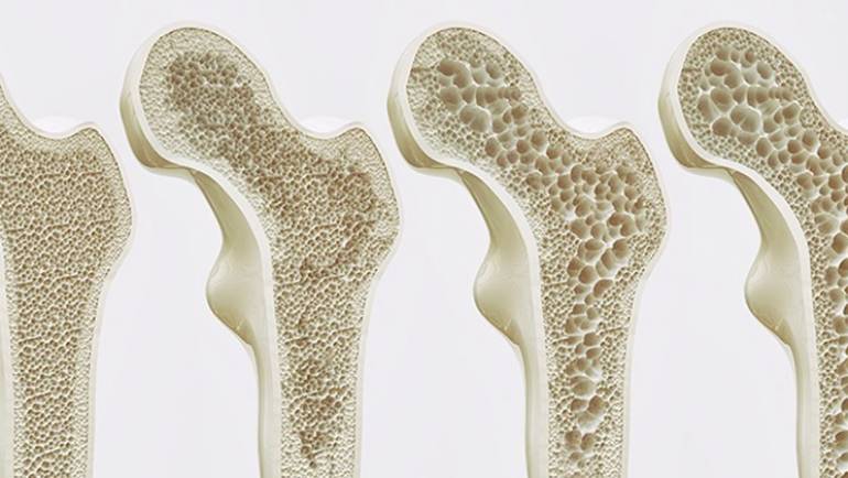 Osteoporosis: la enfermedad metabólica de los huesos.